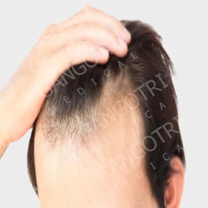 Hair Loss Products